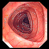 Large intestine