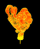 Large intestine,CT scan