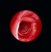Bronchoscope image of normal trachea