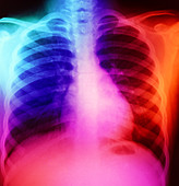 False-colour chest X-ray: normal 7 year-old child