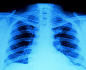 Chest X-ray showing normal lungs and heart