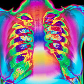 Coloured chest X-ray of a healthy woman