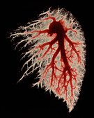 Coloured angiogram of pulmonary arteries of lung