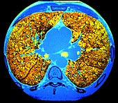 Lungs,CT scan