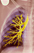 Lung bronchioles,X-ray