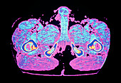 Coloured computed tomography scan of erect penis