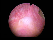 Male urethra,endoscope image