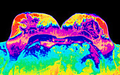 Coloured MRI scan of healthy breasts of a woman