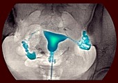 Female reproductive organs,X-ray