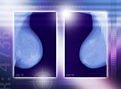 Healthy breasts,X-rays