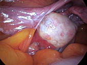 Ovary and fallopian tube