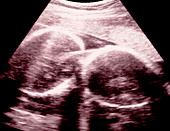 Tinted ultrasound scan of twins at 25 weeks