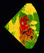 Coloured ultrasound scan of 6-month-old foetus