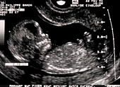 Ultrasound of foetal profile at 12 weeks old