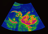Foetus at 21 weeks