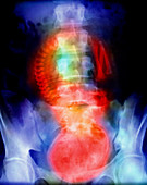 Coloured X-ray of full term foetus