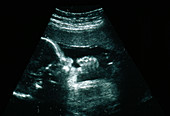 Ultrasound scan of full-term foetus sucking thumb