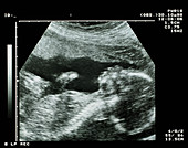 Ultrasound scan of 20 week old foetus sid