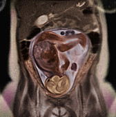 36 week foetus,MRI scan