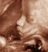 3-D foetal ultrasound