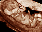 3-D foetal ultrasound