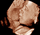 3-D foetal ultrasound