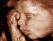 3-D foetal ultrasound