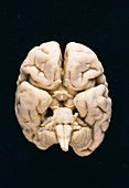 Child's brain