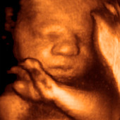 Foetus,3-D ultrasound scan