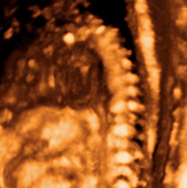 Foetal heart,ultrasound scan