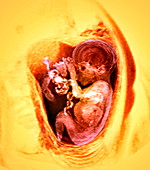 9 month foetus,MRI scan