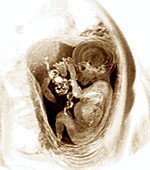 9 month foetus,MRI scan