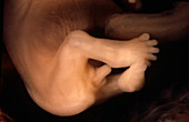 Foetal genitalia at 10 weeks