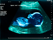 Ultrasound of foetus at 20 weeks
