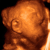 Foetus' head,3-D ultrasound scan