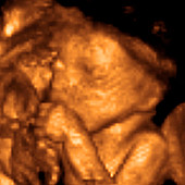 Foetus,3-D ultrasound scan