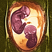 Twin foetuses,coloured MRI scan
