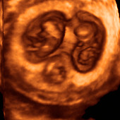 Triplet foetuses,3-D ultrasound scan