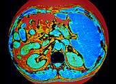 CT scan of human adrenal gland
