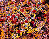 Coloured SEM of adipose tissue showing fat cells