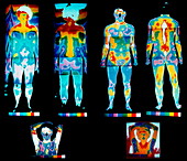 Human body,thermograms