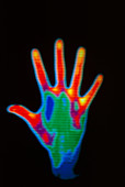 Thermograph of man's hand showing palm upward