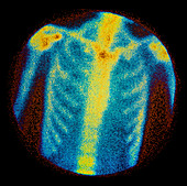 Normal bone scan of chest: anterior view