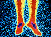 Coloured radionuclide bone scan of lower legs