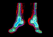 Coloured Gamma scan of lower leg and feet