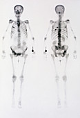 Skeleton gamma scans