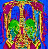 Col. MRI scan of thorax & abdomen of elderly woman