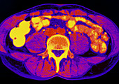 CT scan of abdomen