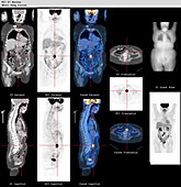 Whole body,CT and PET scans