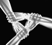 X-ray of a triangle of three linked hands